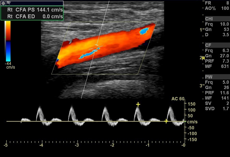 Arterial Ultrasound